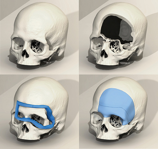 Simple-Cranial-Guide-and-Implant-Design.jpg